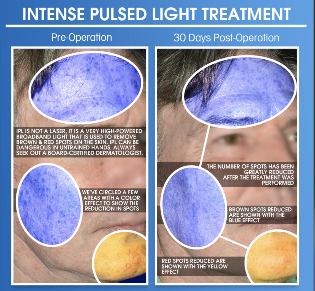 Intense pulsed light IPL treatment reducing facial spots before and after
