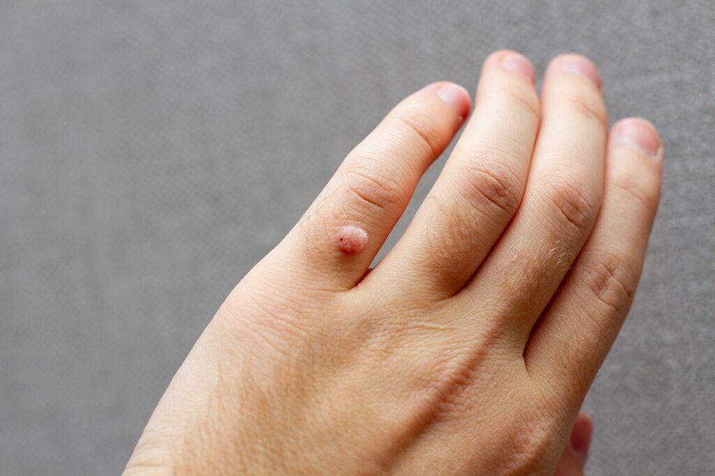 Wart removal treatment by a dermatologist