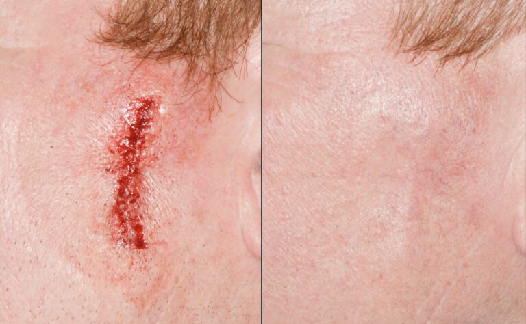 Re-Excision Left Distal Arm