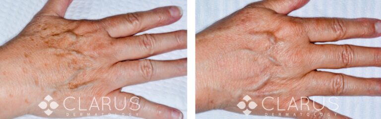 Dark Spot Treatment - Hands