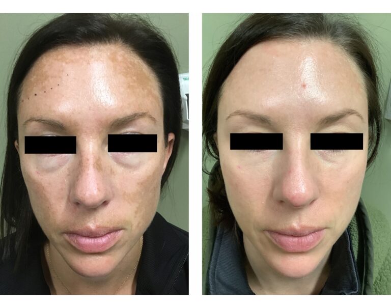 Medium Depth Chemical Peel