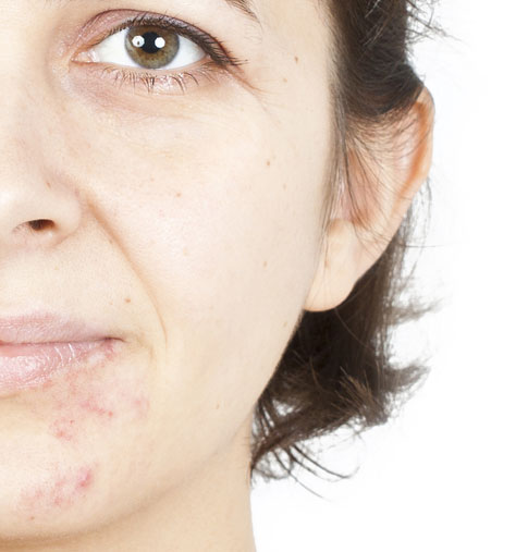 Medical Chemical Peel