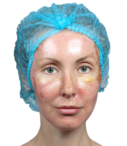 Salicylic acid peel