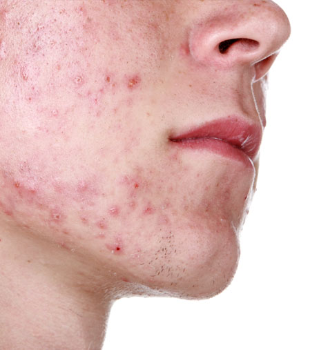 Hormonal Acne