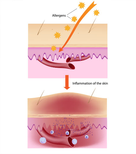 Eczema Cause