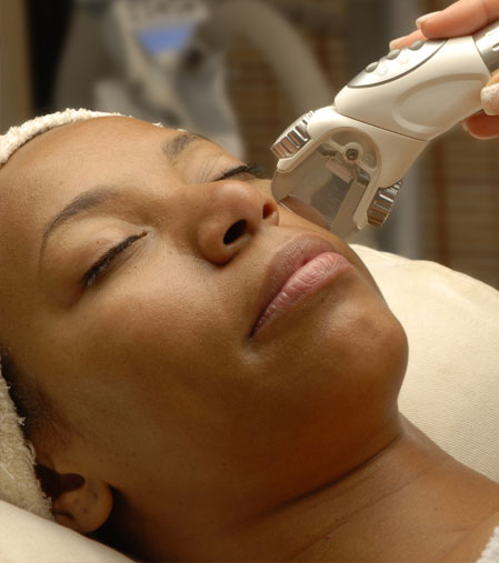 Laser treatment of rosacea