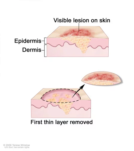 Mohs removal through surgery