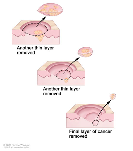 Mohs removal through surgery