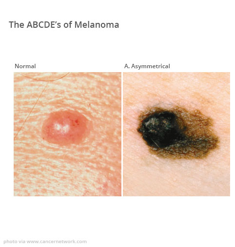 Melanoma excision