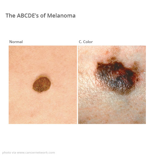 Melanoma surgery