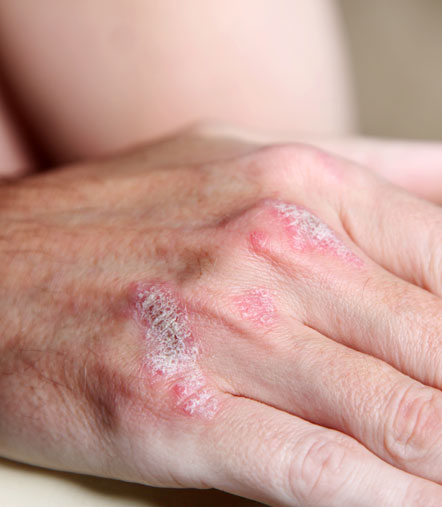 Psoriasis treatments