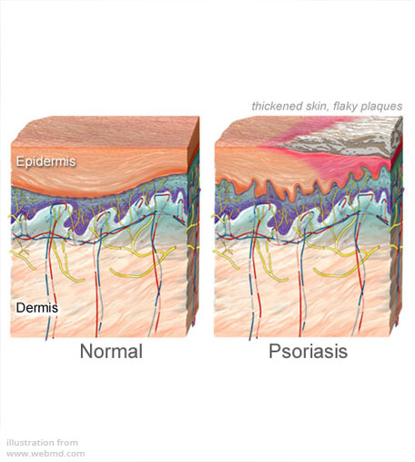 psoriasis care