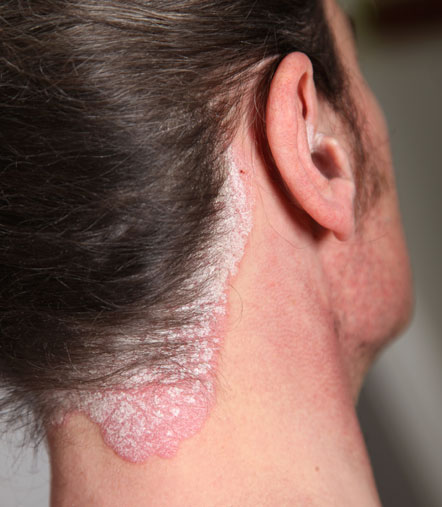 Psoriasis treatments