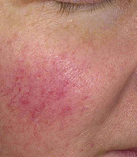 Rosacea Treatments