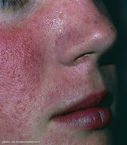 Rosacea treatment