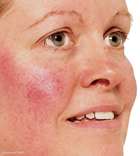 Rosacea treatment