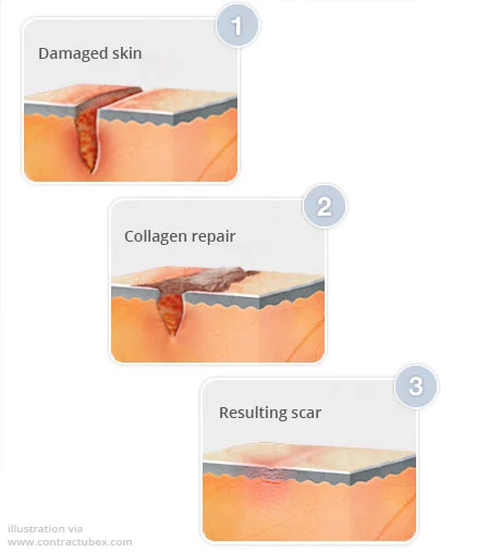 Laser treatment for acne scars