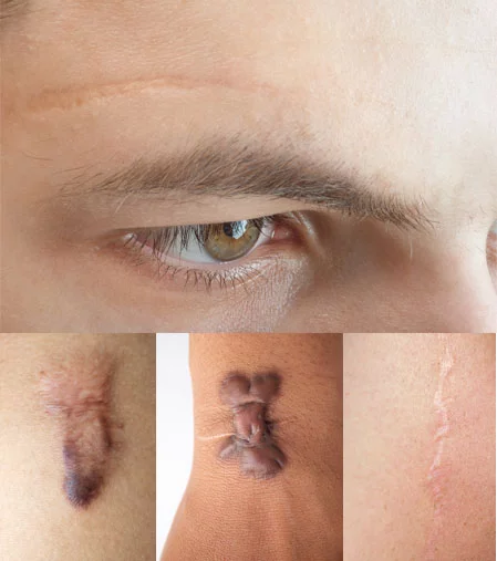 Scars removal