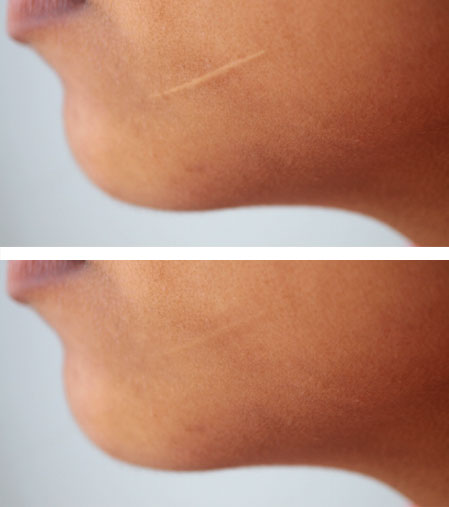 Scars treatment