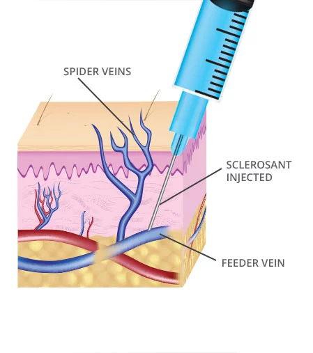 Sclero therapy