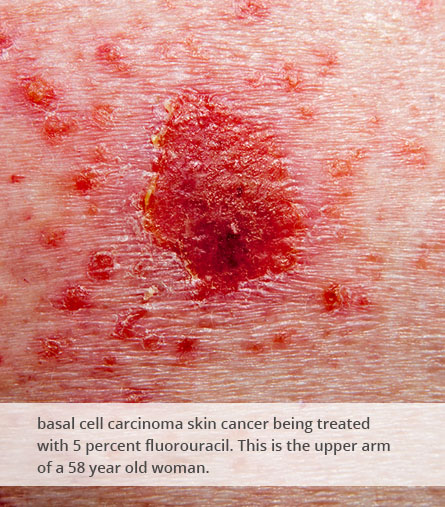 Skin cancer treatment