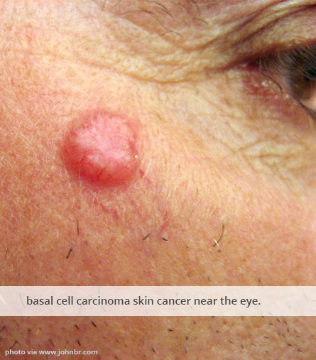 Carcinoma skin cancer treatment