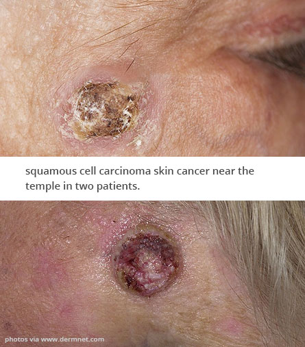 Surgical dermatology for skin cancer