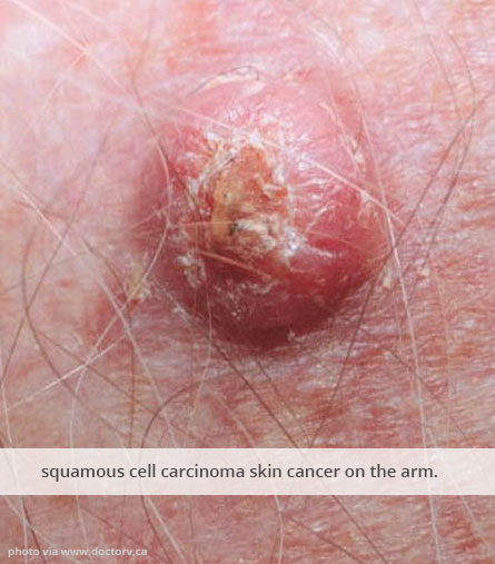 Skin cancer treatment on arms