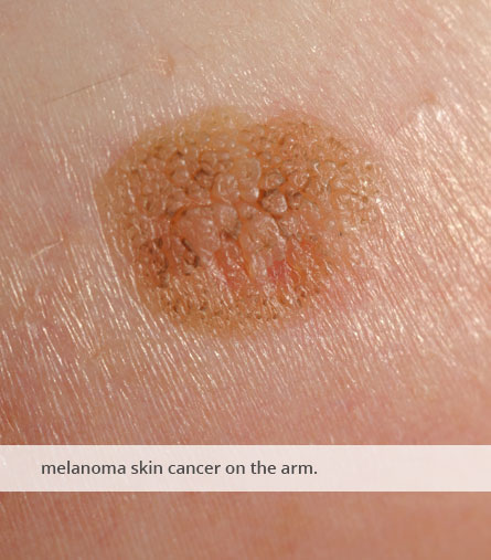 Melanoma cancer on arms care