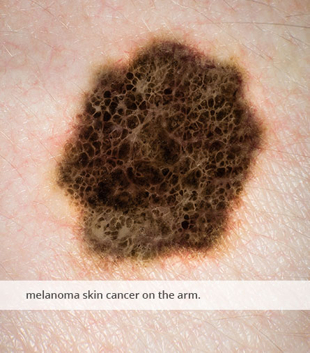 Melanoma skin cancer