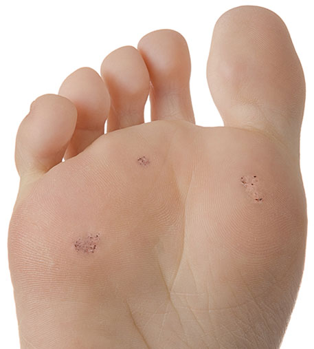 Warts treatments