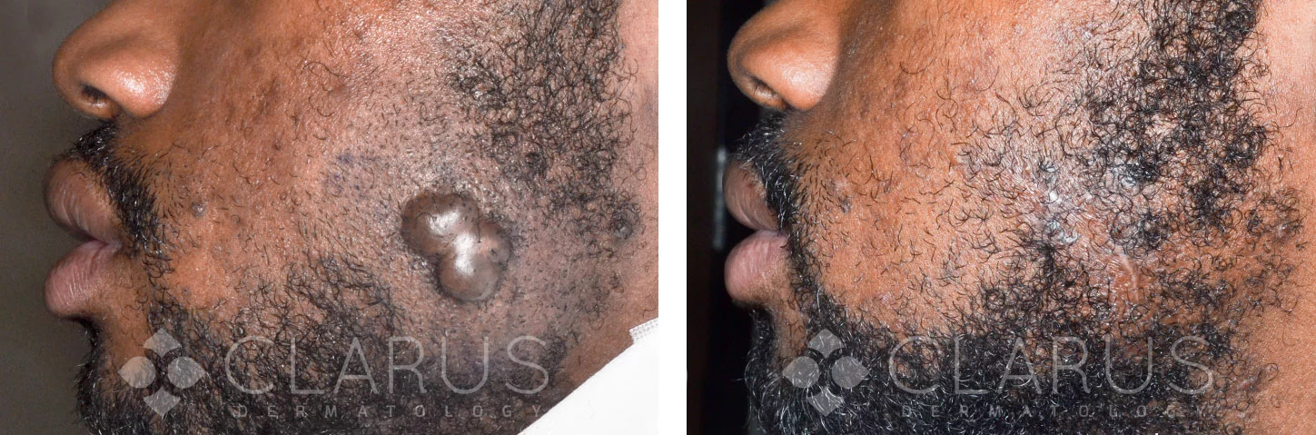 Keloid tumor excision