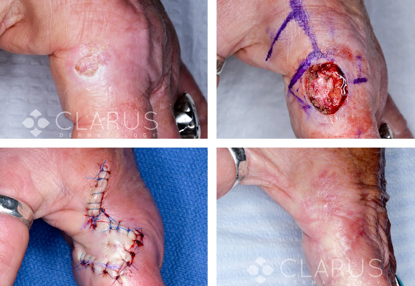 Mohs surgery on fingers