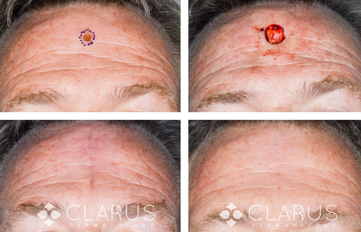 Mohs surgery – Surgical Dermatology