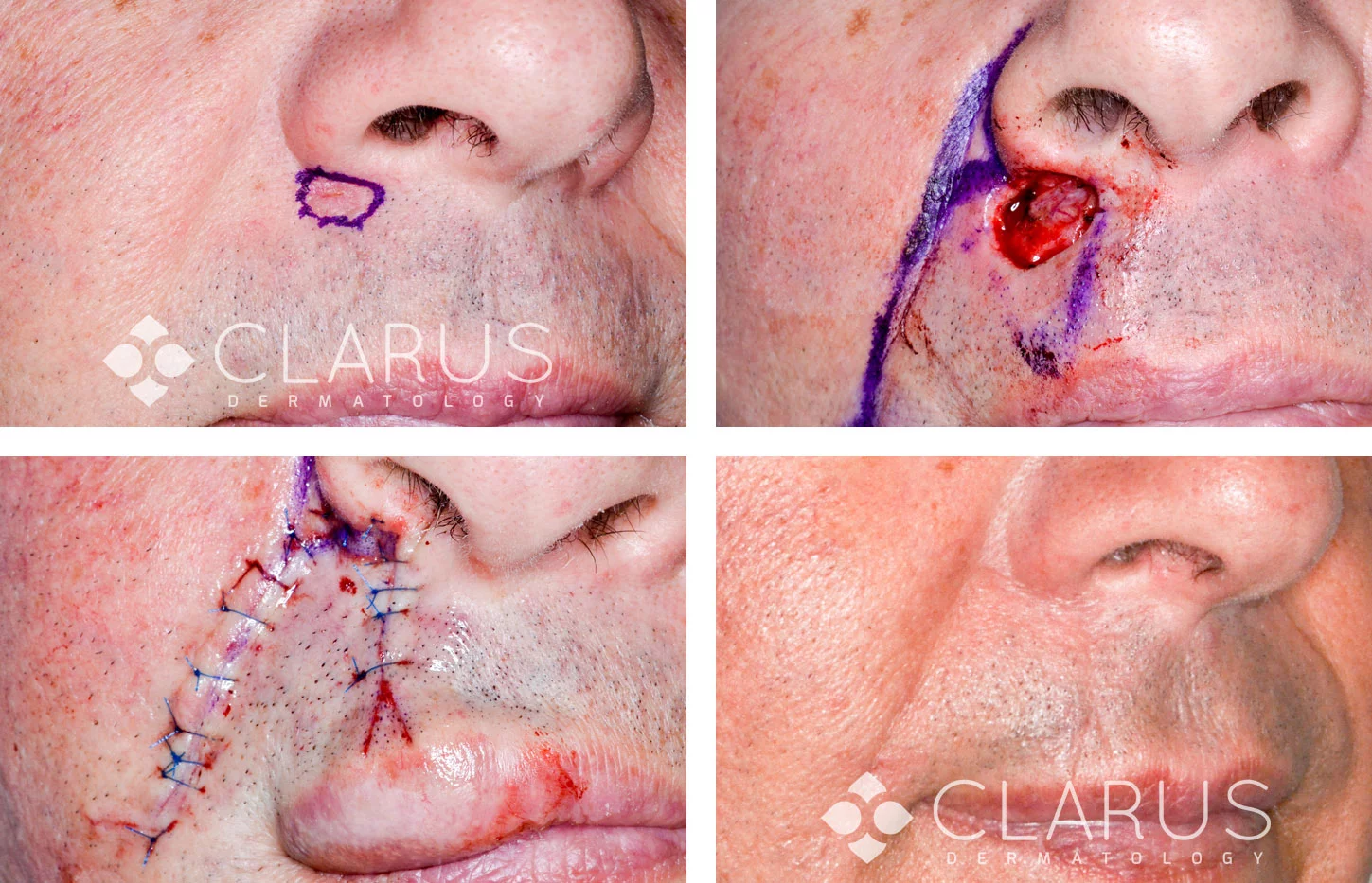 Mohs facial surgery