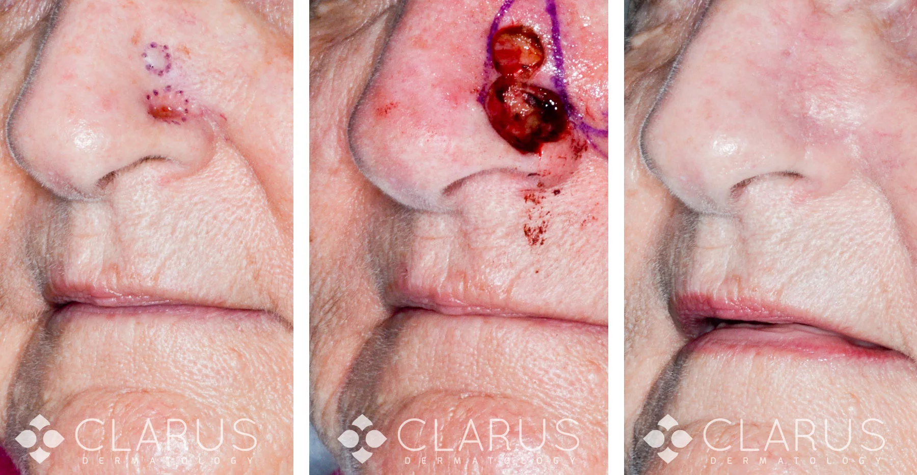 Mohs procedure on nose