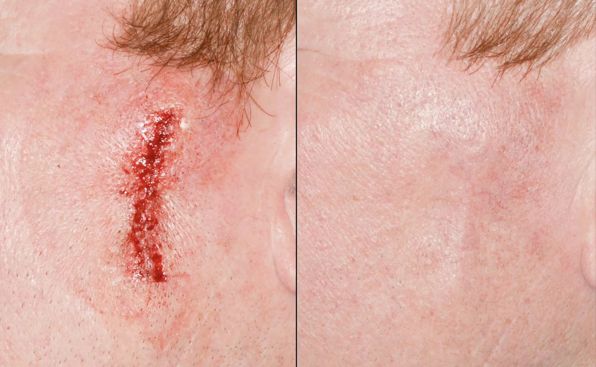Skin cancer treatment for the squamous cells