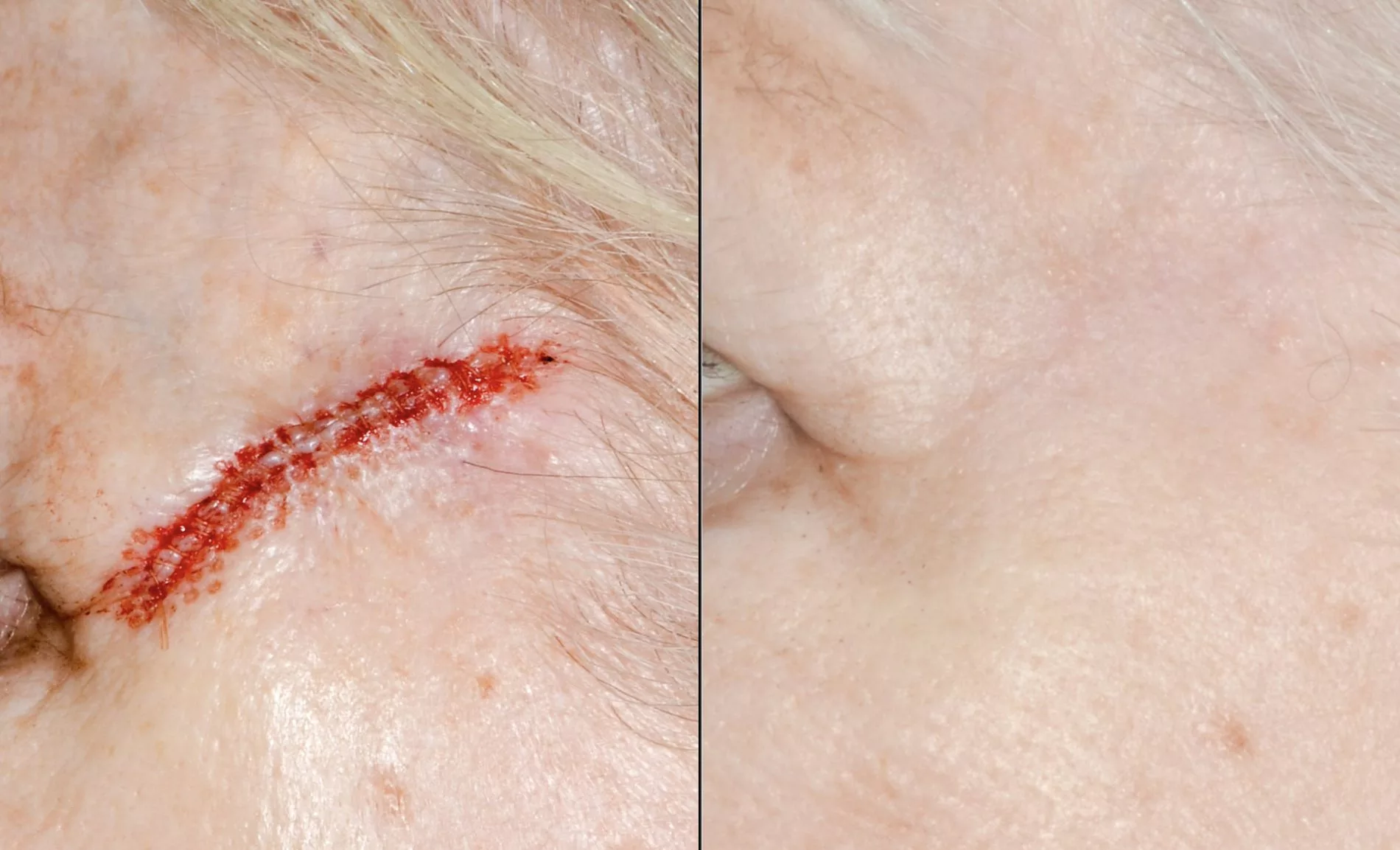 Mohs procedure for skin cancer