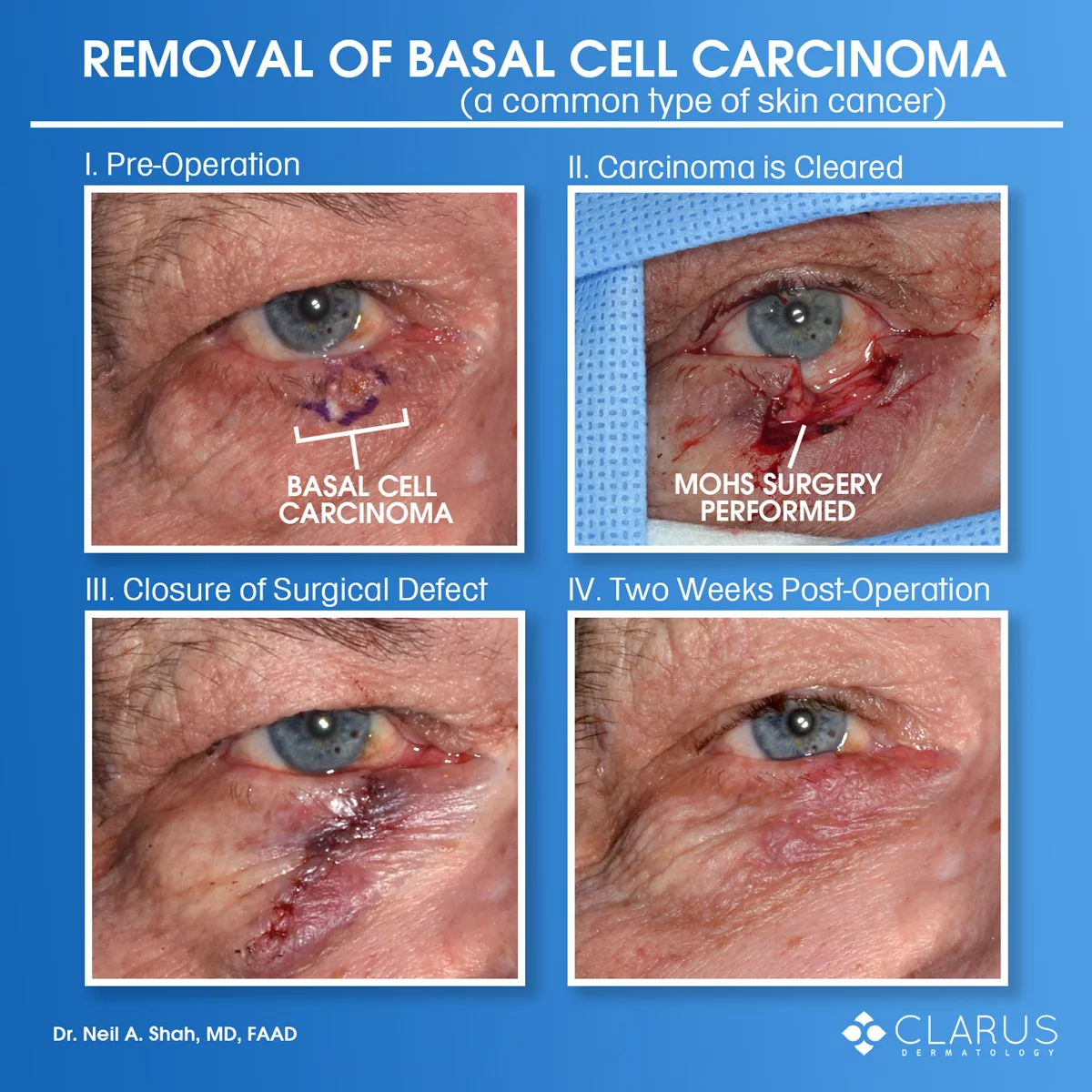 These were taken of a patient that had basal cell carcinoma, a common type of skin cancer, on their eyelid. Dr. Neil Shah performed Mohs surgery at Clarus Dermatology to remove the cancer. The surgical defect was then immediately repaired.