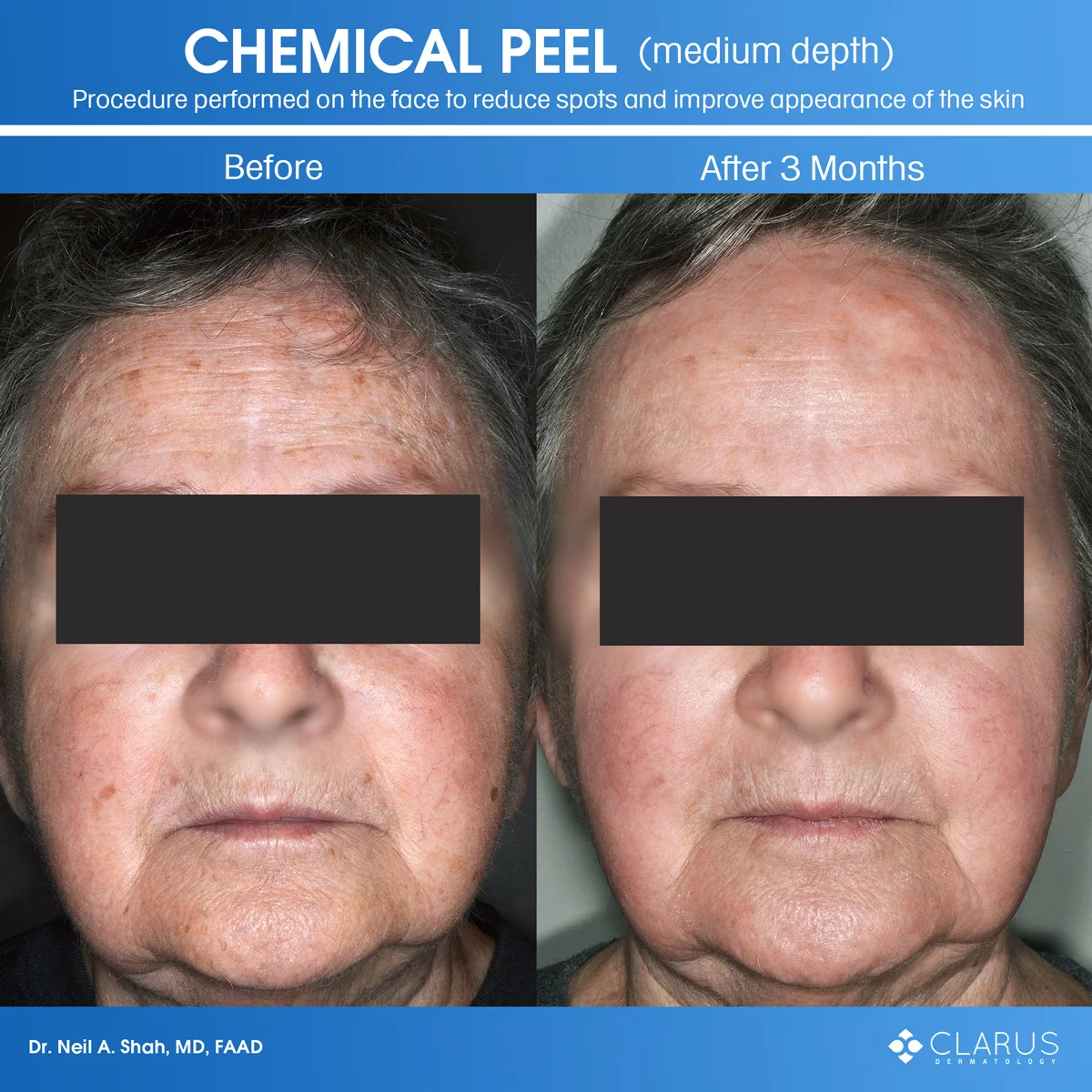 We perform a number of cosmetic treatments at Clarus Dermatology and among them, chemical peels are time-tested, high-value, and popular for dealing with acne, sun-damage, and precancerous skin growths.