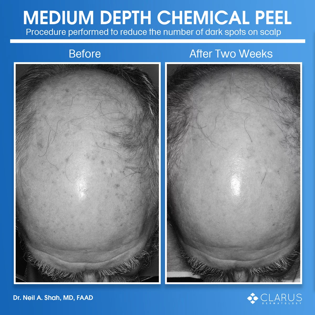 A patient visited our clinic and Dr. Shah performed a medium depth chemical peel on the patient's scalp to reduce the number of brown spots. Even though we own a lot of lasers, we often perform chemical peels at the clinic because they are safe, well-tolerated and highly cost-effective.