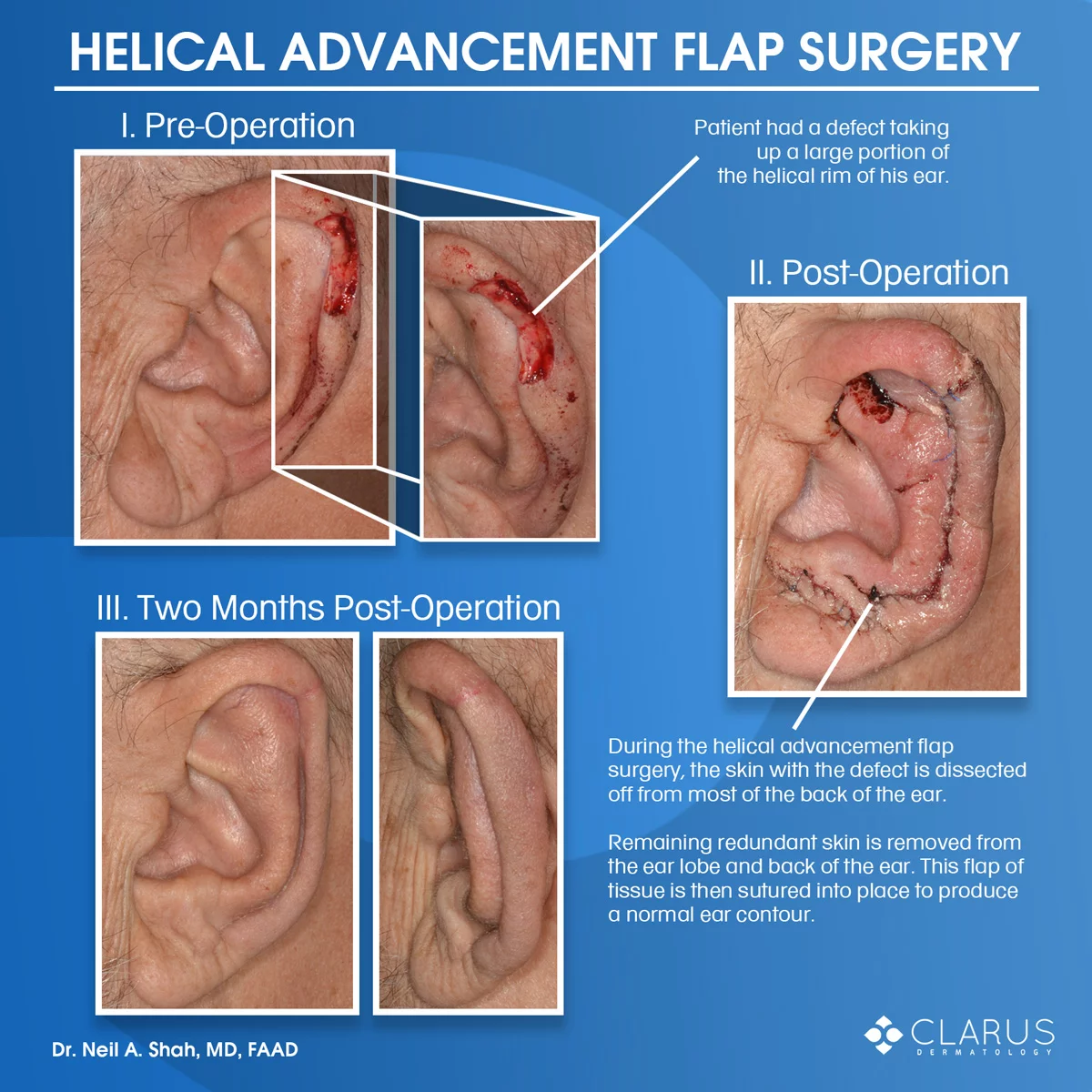 We recently saw a patient here at Clarus Dermatology who needed Mohs surgery to clear a skin cancer on the ear (helical rim). The resulting defect was reasonably broad and fairly deep. In order to restore a preoperative ear shape a helical advancement flap was undertaken and performed by Dr. Neil Shah.