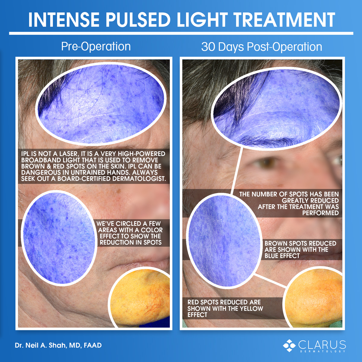 At Clarus Dermatology, we see a lot of patients for IPL treatment to reduce the number of brown and red spots on their skin. Contrary to what you might think, the L in IPL does not stand for laser but rather light. IPL is short for Intense Pulsed Light; the treatment involves a very high-powered broadband light - imagine a really bright flashlamp. IPL is an incredibly powerful device that can burn the skin with relative ease, which means that it can be quite dangerous in untrained hands - for this reason it is one of the most litigated cosmetic procedures. We always recommend seeing a board-certified dermatologist for your skin care needs and IPL is absolutely no exception. For this patient, Dr. Neil Shah personally performed the entire procedure using two skilled passes of the light at a relatively high energy setting in a single treatment to achieve the results that you see in the images.
