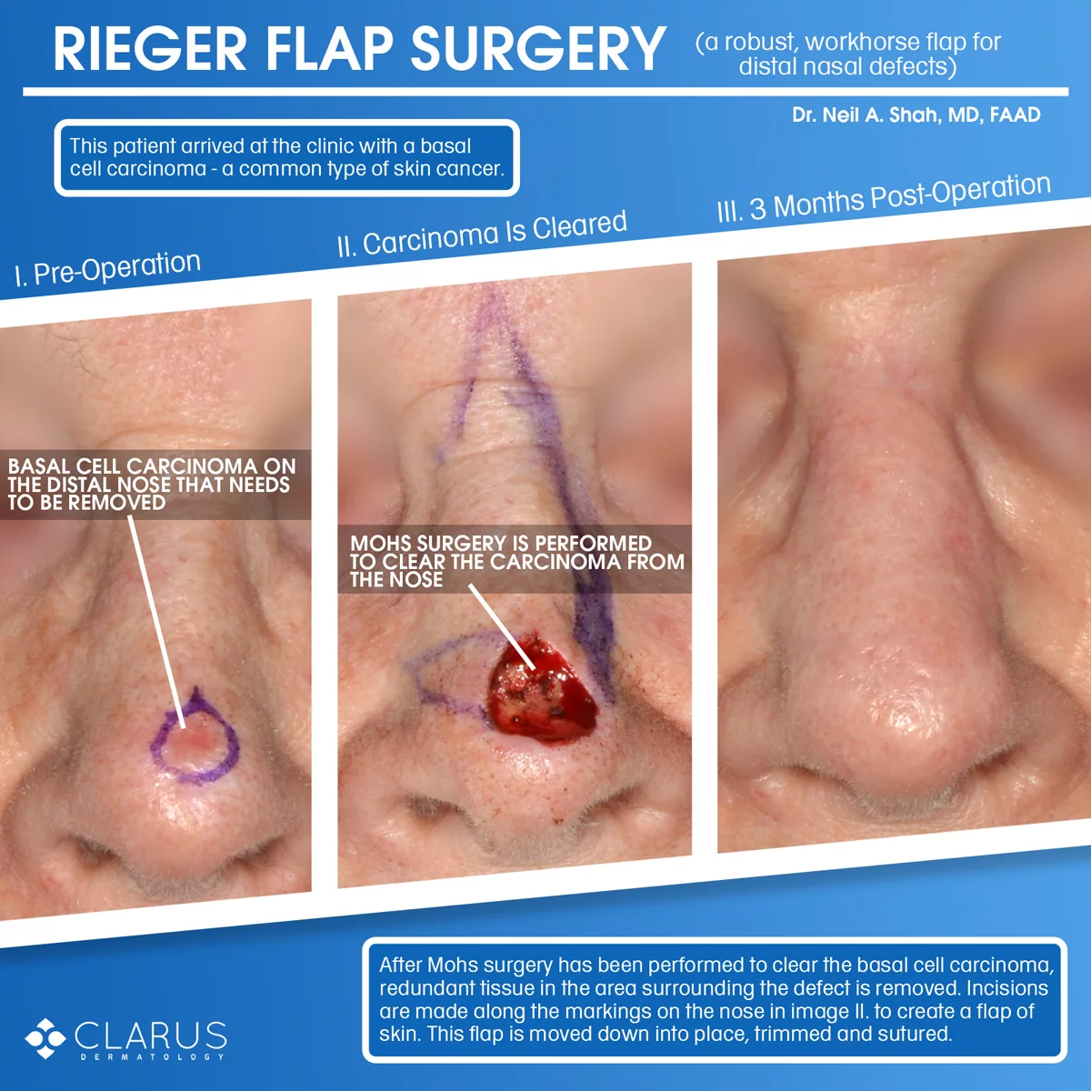 We recently treated a patient here at Clarus Dermatology who arrived at the clinic with a basal cell carcinoma (a common type of skin cancer) on her nose. The patient was evaluated by Dr. Neil Shah, who recommended Mohs surgery to clear the tumor. Two stages of Mohs surgery were required to clear the tumor (image II. was taken after tumor clearance). After the skin cancer was removed, a Rieger flap was undertaken to repair the nose.