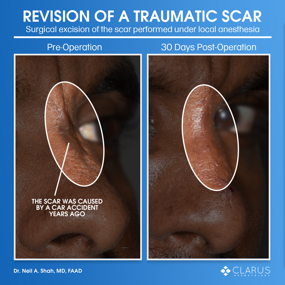 At Clarus Dermatology, we see quite a bit of scar revision referrals. The images below show the case of a patient with a traumatic scar caused by a car accident years ago. Dr. Shah performed a surgical excision of the scar under local anesthesia to provide the patient with a better aesthetic outcome.