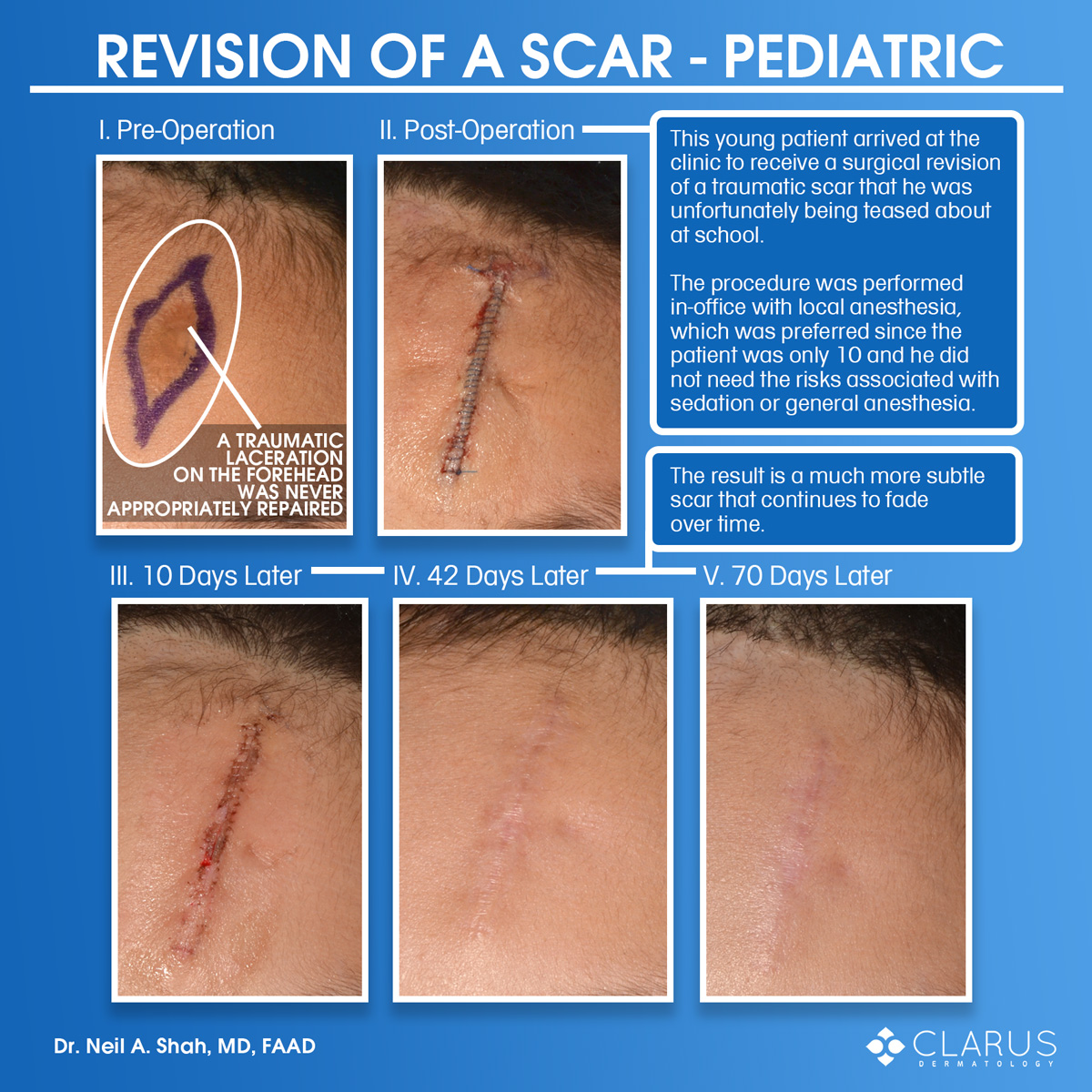 We recently saw a young patient here at Clarus Dermatology who needed to have a surgical revision of a traumatic scar.