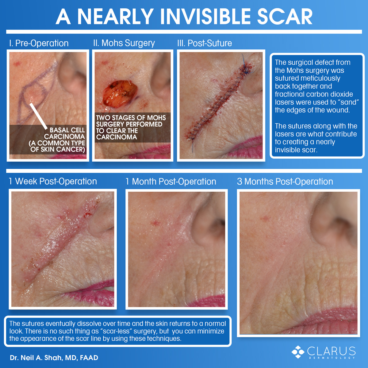 One of the reasons that Clarus Dermatology gets so many referrals from other dermatologists is because of the quality of our scar outcomes. In the case of this patient, the scar is nearly invisible only three months post-operation.