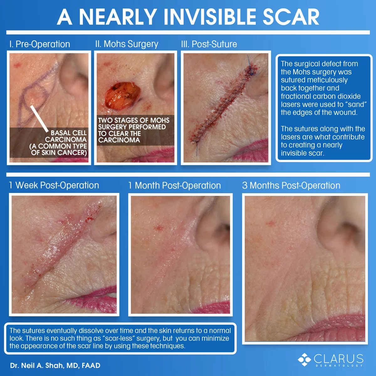 One of the reasons that Clarus Dermatology gets so many referrals from other dermatologists is because of the quality of our scar outcomes. In the case of this patient, the scar is nearly invisible only three months post-operation.