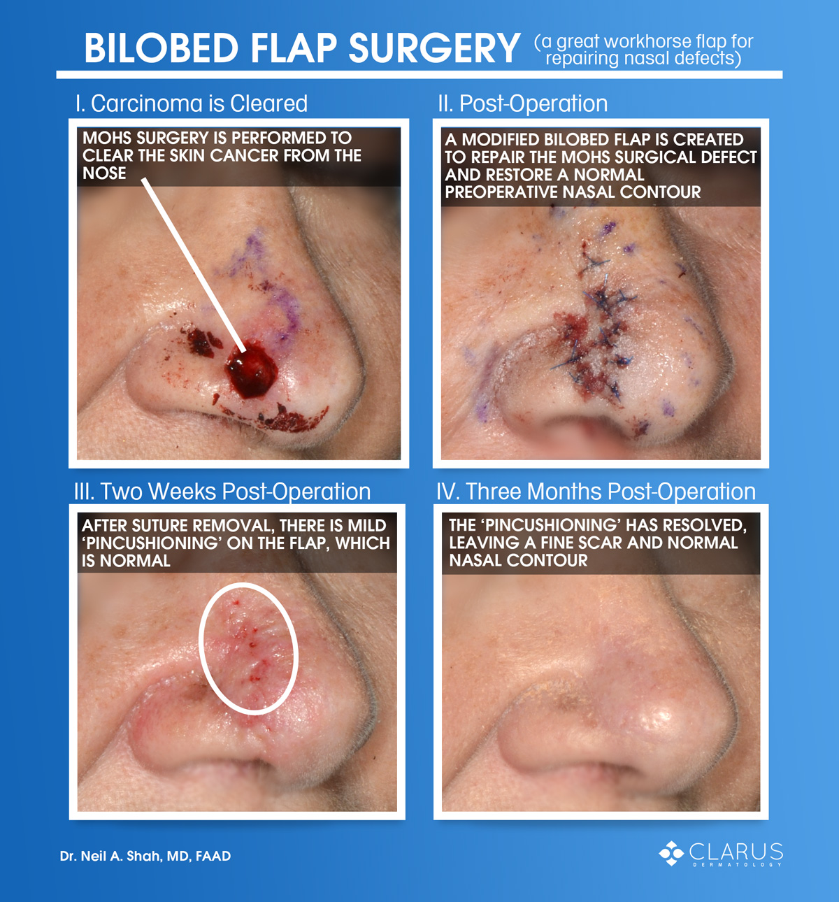The images here are from a patient of ours that had skin cancer on her nose. Board-certified dermatologist Dr. Neil Shah performed Mohs surgery to clear the carcinoma on the nose (seen in image I.). Dr. Shah then performed a bilobed flap surgery to repair the mid-sized off-center distal nasal defect left behind after the carcinoma was cleared. After the bilobed flap, the normal contour of the nose was reconstructed (seen in image II.).