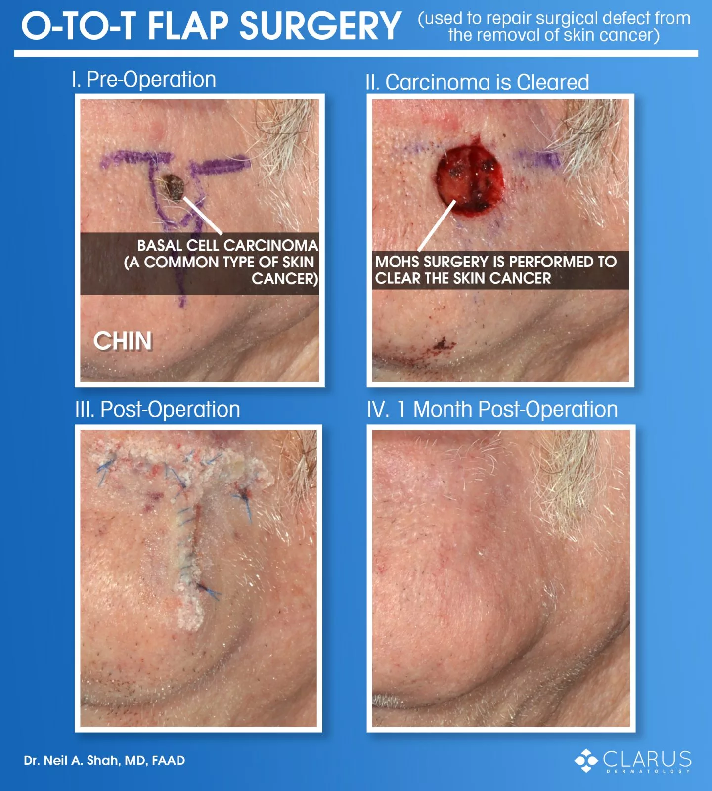 One of the reasons that we have so many satisfied patients at Clarus Dermatology is because of our quality aesthetic outcomes from surgical procedures. The images here are from a patient that had a basal cell carcinoma, a common type of skin cancer, on his chin. Even though the scar is nearly undetectable a month post-operation, there is a lot of unseen effort to achieve that outcome.